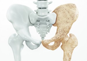 Osteoporosis upper limb bones